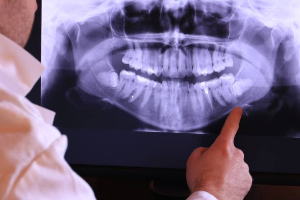 Best Knocked-Out Tooth (Avulsed Tooth) Treatment in St James City, FL