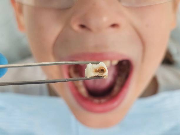 Best Emergency Root Canal Therapy in St James City, FL